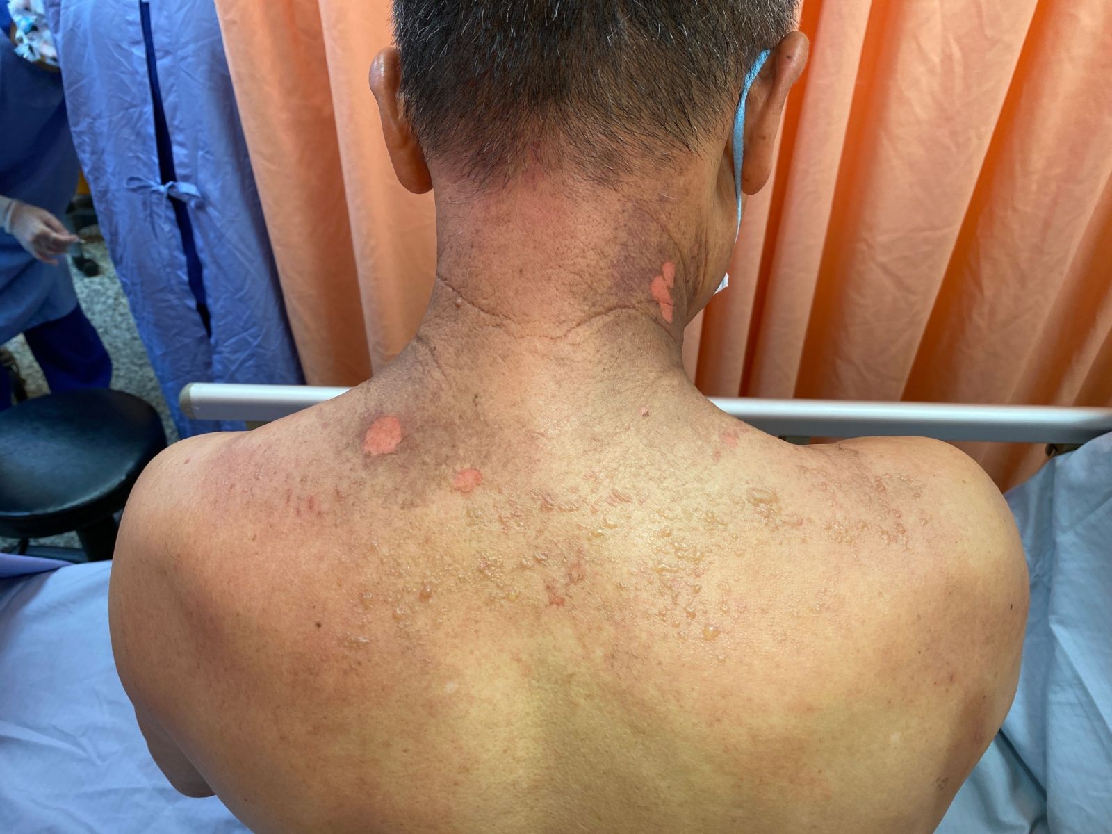 影／阿北用精油按摩舒壓竟然灼傷　肇因沒稀釋精油 - https://www.watchmedia01.com