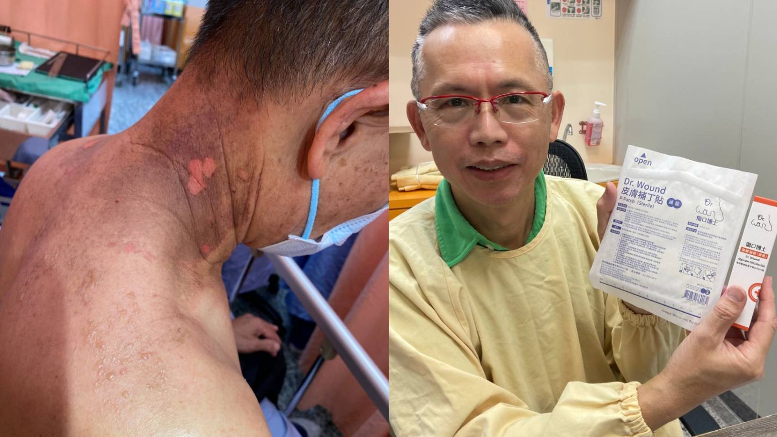 影／阿北用精油按摩舒壓竟然灼傷　肇因沒稀釋精油 - https://www.watchmedia01.com