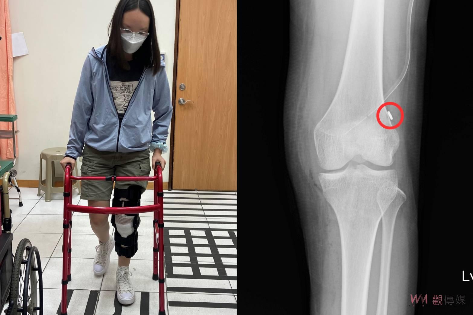 影／蒙古少女膝關節十字韌帶斷裂　員榮醫院骨科讓她重回運動場 - https://www.watchmedia01.com