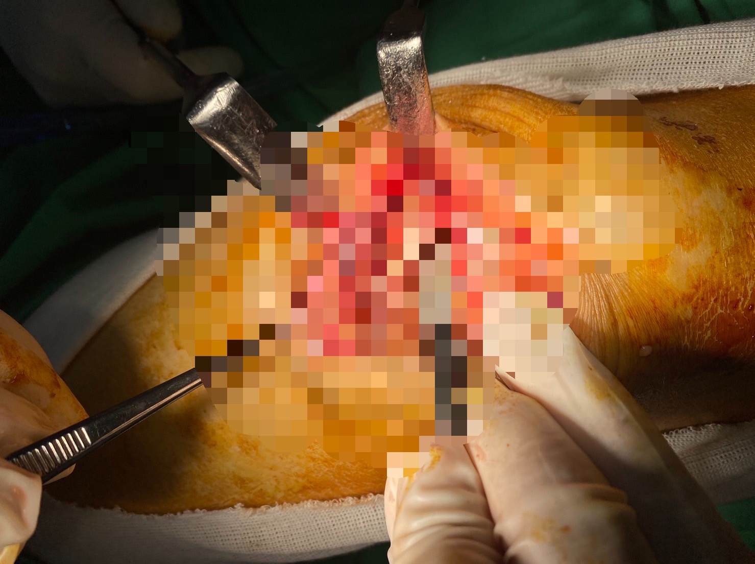 登山翁和舉重女神「傷同處」員榮醫院助他重新站起來 - https://www.watchmedia01.com