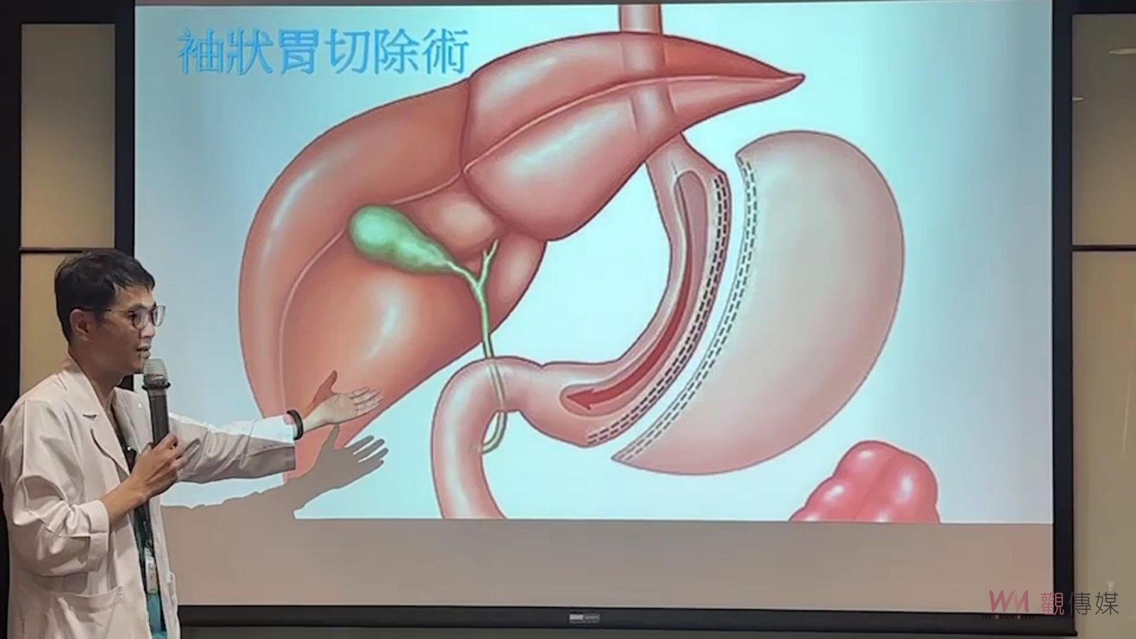 影／肥仔變型男　微創減重手術找回健康　享瘦美好人生 - https://www.watchmedia01.com
