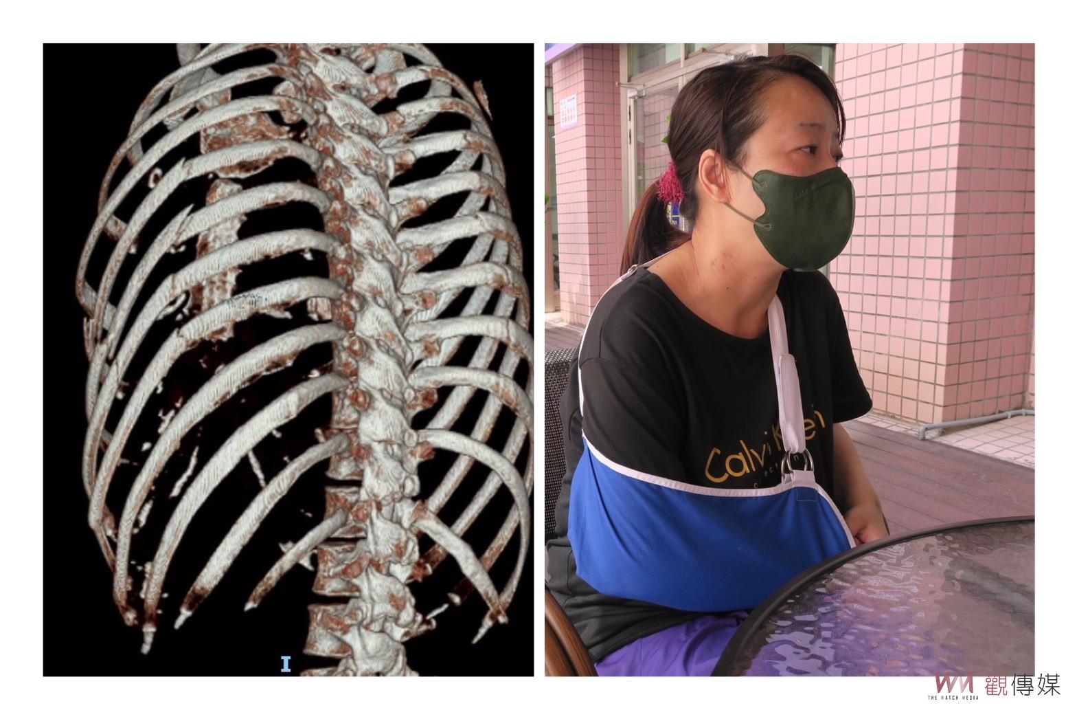 影／車禍肋骨斷9根！彰化醫院微創肋骨手術　女子擺脫「痛不欲生」 - https://www.watchmedia01.com