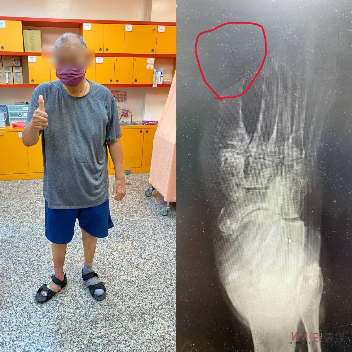 影／差點截肢！右腳腫得像「麵龜」糖尿病患者腳底爛到小腿 - https://www.watchmedia01.com