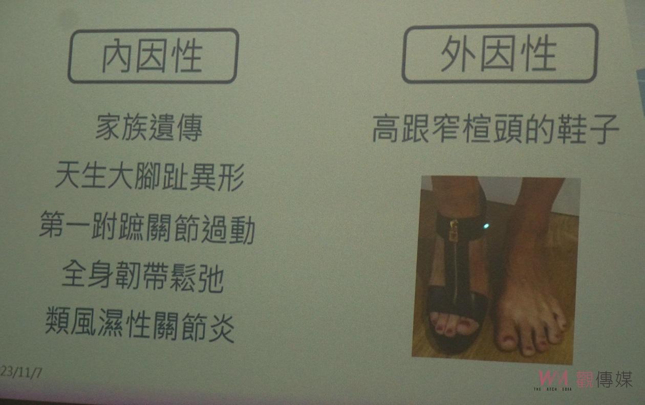 （有影片）／足部承受全身重量要重視健康　大腳趾外翻和趾部變形治療方法 - https://www.watchmedia01.com