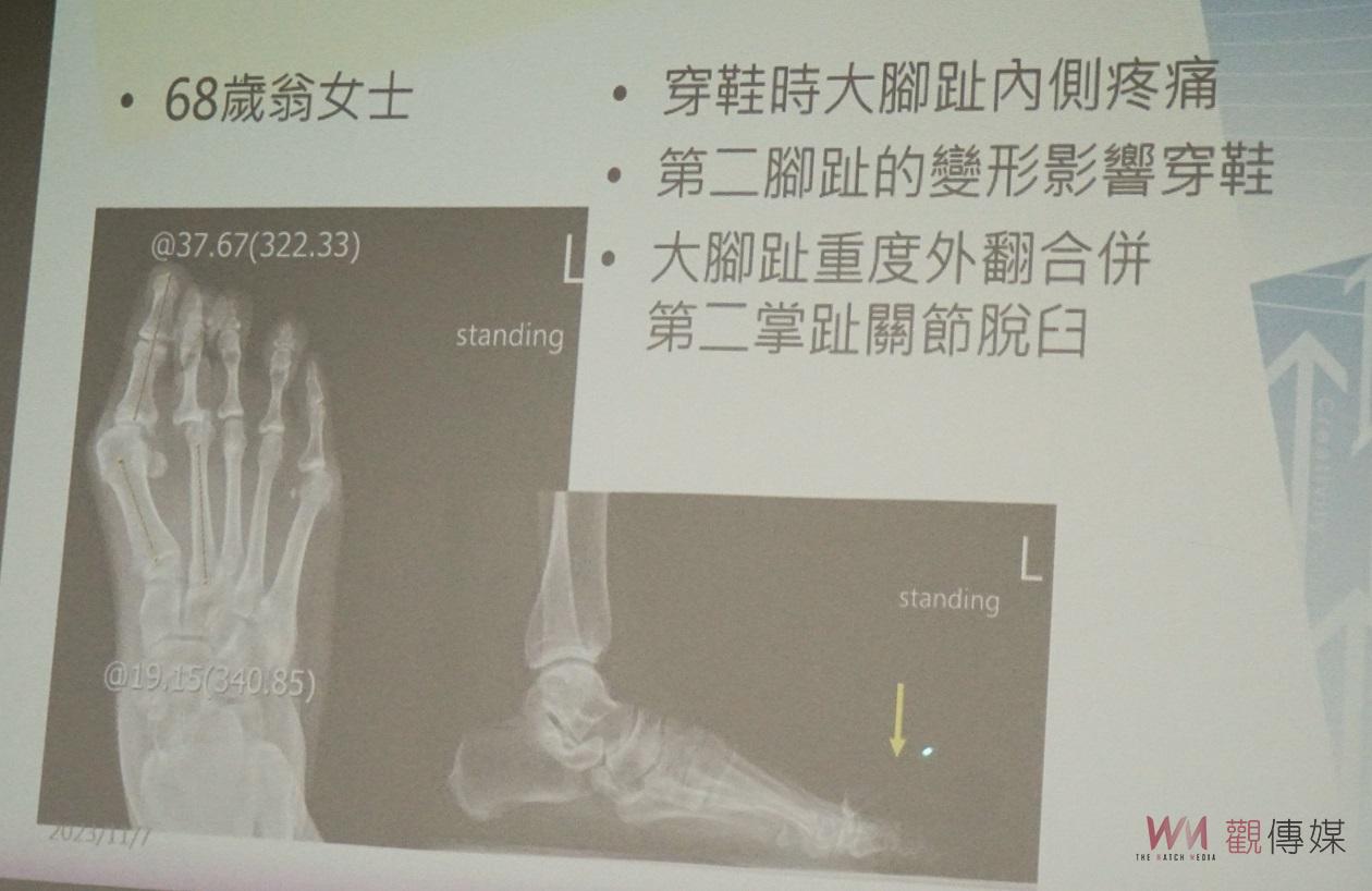 （有影片）／足部承受全身重量要重視健康　大腳趾外翻和趾部變形治療方法 - https://www.watchmedia01.com