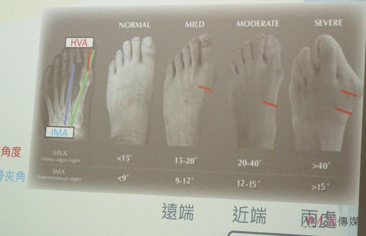（有影片）／足部承受全身重量要重視健康　大腳趾外翻和趾部變形治療方法 - https://www.watchmedia01.com