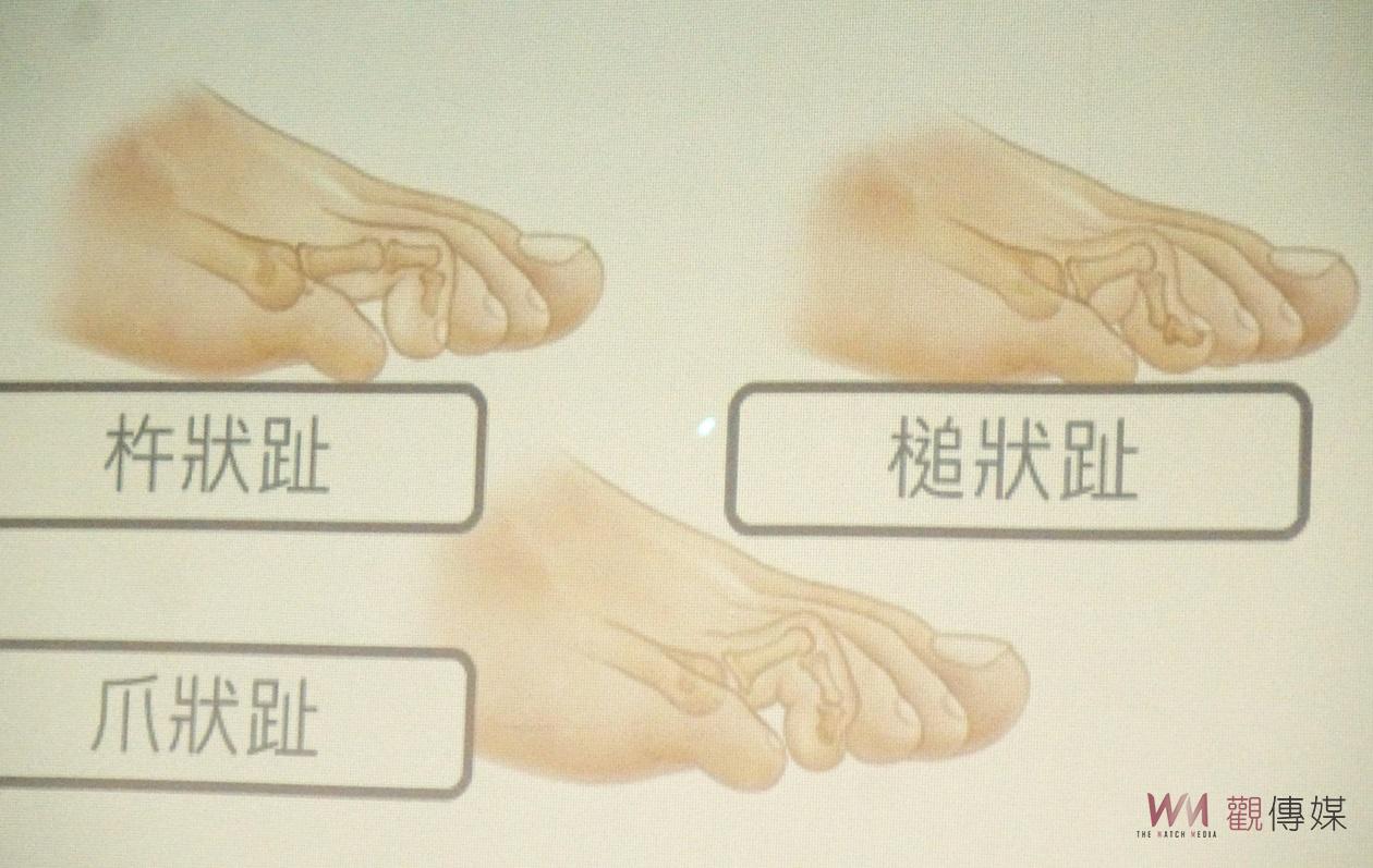 （有影片）／足部承受全身重量要重視健康　大腳趾外翻和趾部變形治療方法 - https://www.watchmedia01.com