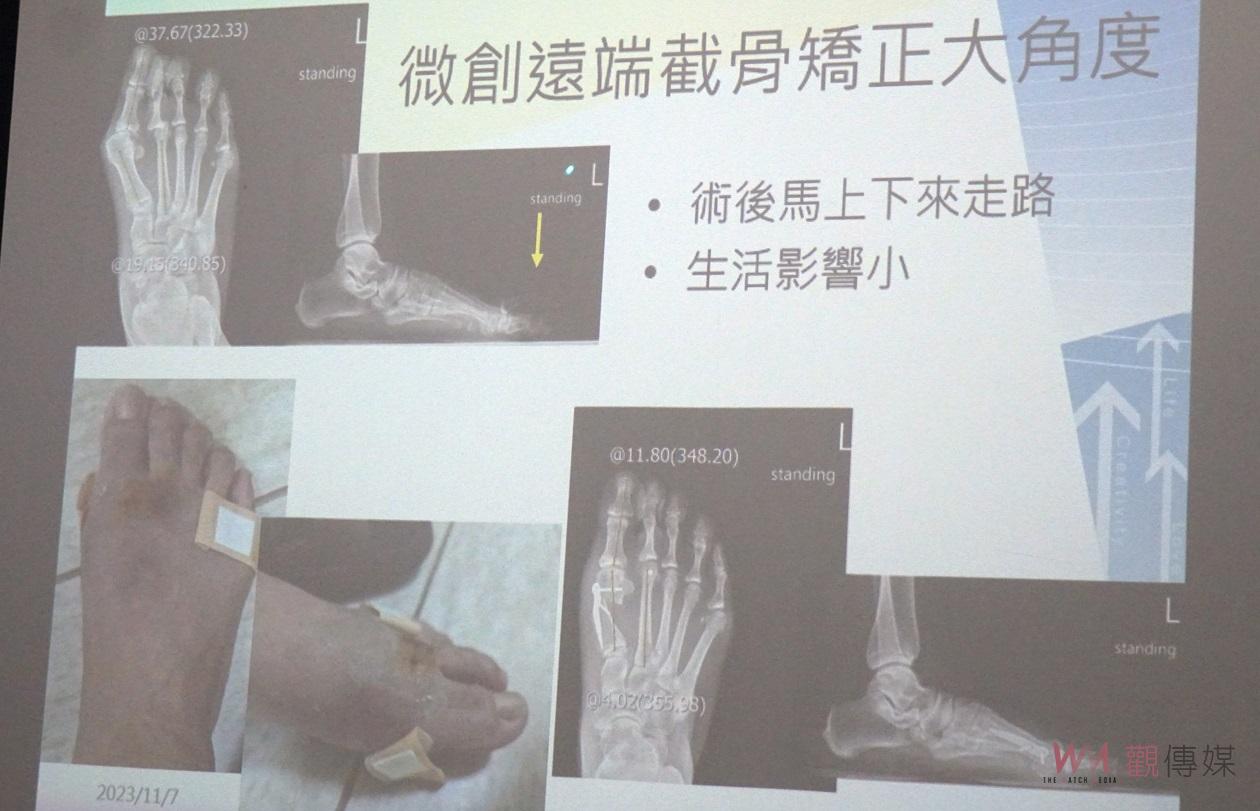 （有影片）／足部承受全身重量要重視健康　大腳趾外翻和趾部變形治療方法 - https://www.watchmedia01.com