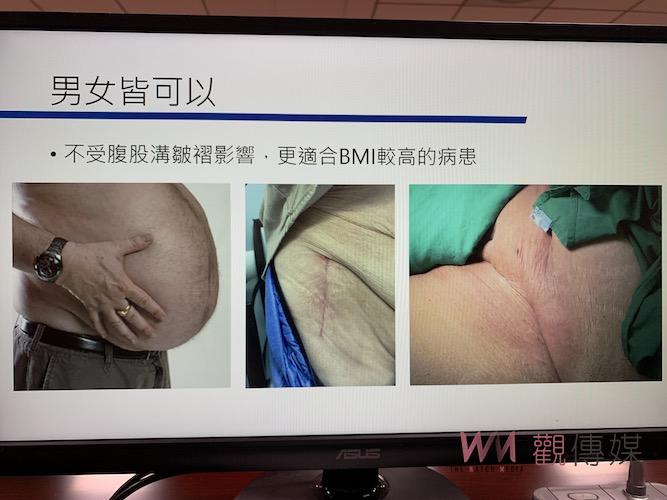 全國首屈一指髖關節置換福音　嘉義長庚創新研發比基尼切口正前位手術 - https://www.watchmedia01.com
