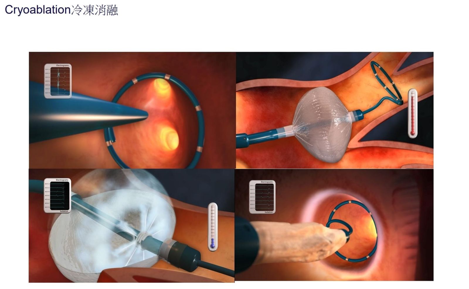 （有影片）／心房顫動致中風是一般人五倍　冷凍消融手術降低病人復發率 - https://www.watchmedia01.com