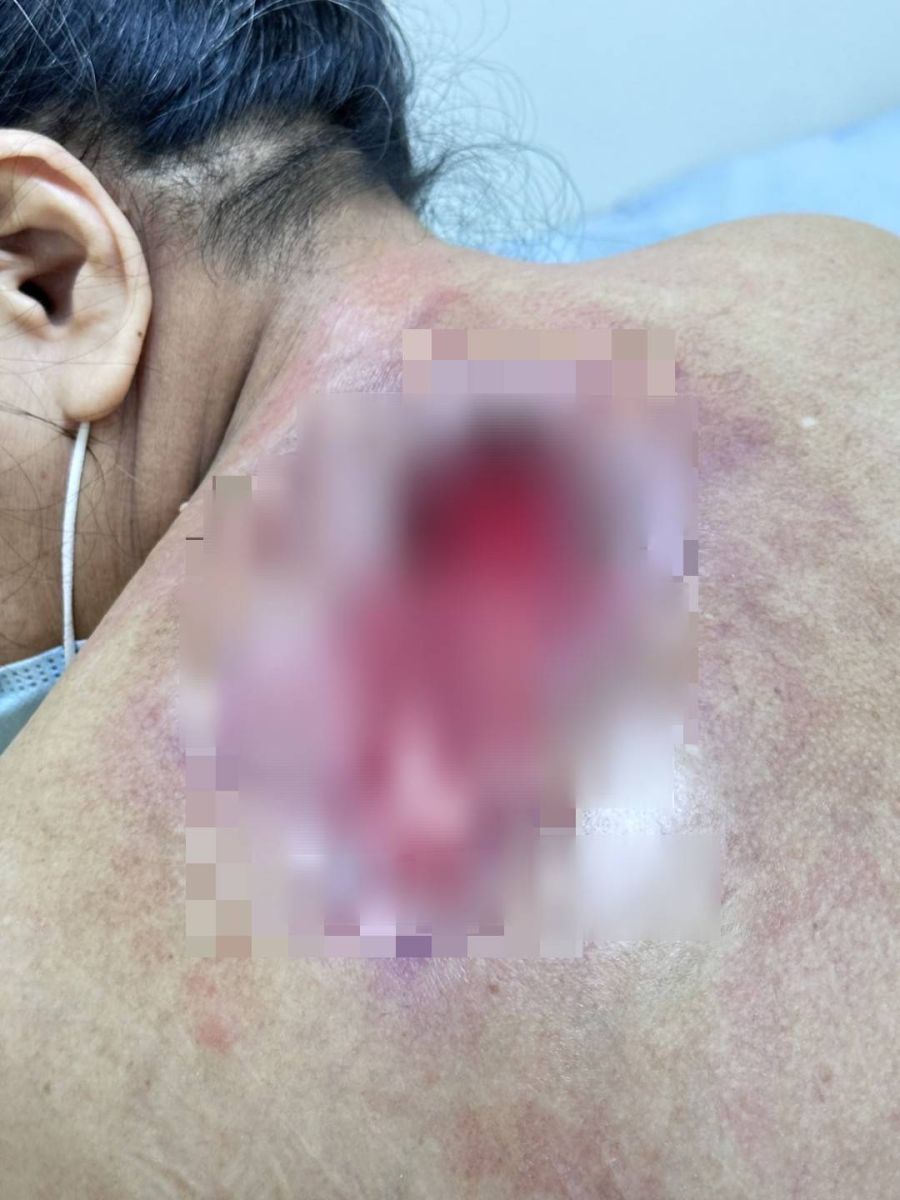 疔子自處理引發組織炎！61歲糖尿病患者10公分傷口3月艱辛康復 - https://www.watchmedia01.com