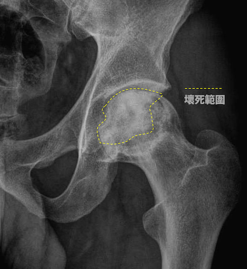 不當飲酒影響骨骼健康　朴子醫院賴彥州醫師提醒年終尾牙聚餐要小心 - https://www.watchmedia01.com
