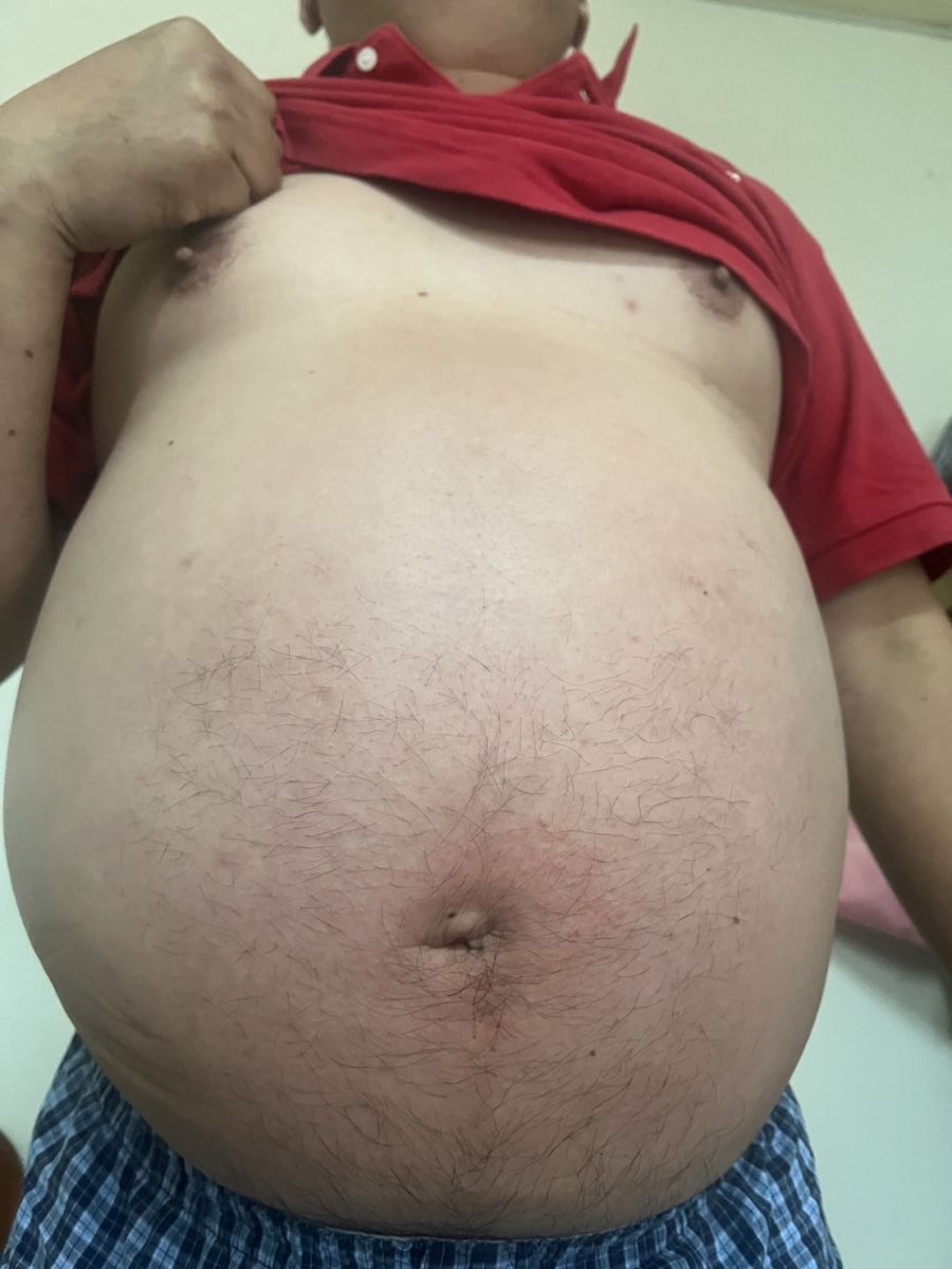 中年男肚大如懷三胞胎　心臟病發作昏倒山頂　幸獲救接受EECP療法 - https://www.watchmedia01.com