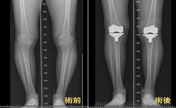 機器手臂雙膝關節置換術　長安醫院：助7旬婦重拾健步如飛 - https://www.watchmedia01.com
