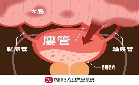 七旬老翁餐廳外高燒昏厥！光田綜醫：泌尿道感染主因是大腸破洞 - https://www.watchmedia01.com