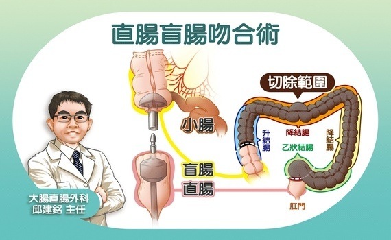 腸道完全失能！日吞百顆瀉藥30年　台中慈濟醫院療心治腸迎接新人生 - https://www.watchmedia01.com
