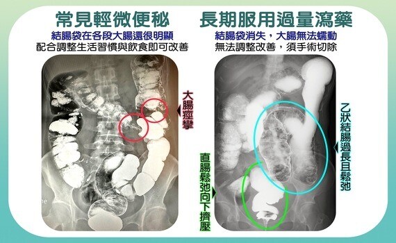 腸道完全失能！日吞百顆瀉藥30年　台中慈濟醫院療心治腸迎接新人生 - https://www.watchmedia01.com