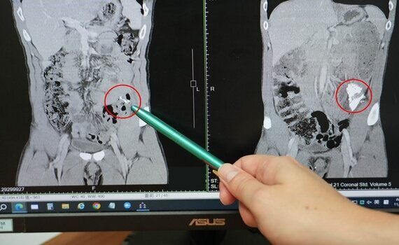 健身男突發腹痛　光田醫院：查出極少見惡性肉瘤 - https://www.watchmedia01.com