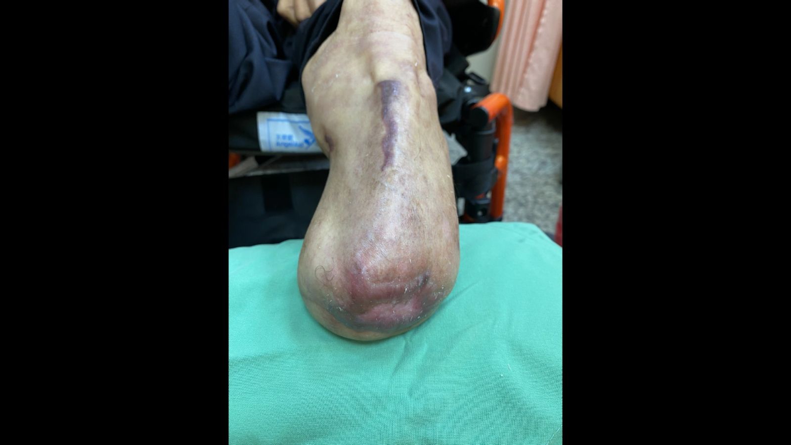 （有影片）／糖尿病患者應定期檢查足部　早期處理傷口可避免截肢危機 - https://www.watchmedia01.com