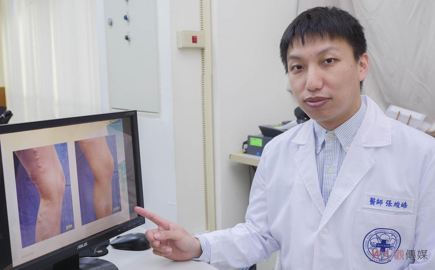 （有影片）／靜脈曲張浮腳筋不再煩惱！　微創雷射術助患者重拾健康生活 - https://www.watchmedia01.com