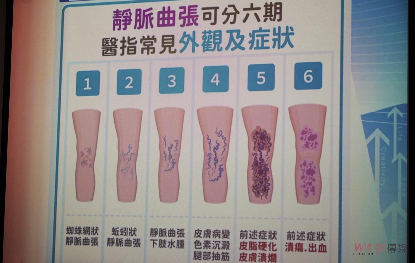 （有影片）／靜脈曲張浮腳筋不再煩惱！　微創雷射術助患者重拾健康生活 - https://www.watchmedia01.com