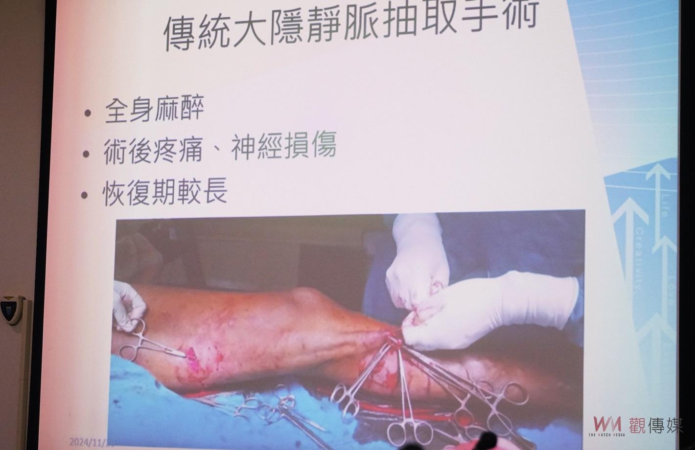 （有影片）／靜脈曲張浮腳筋不再煩惱！　微創雷射術助患者重拾健康生活 - https://www.watchmedia01.com