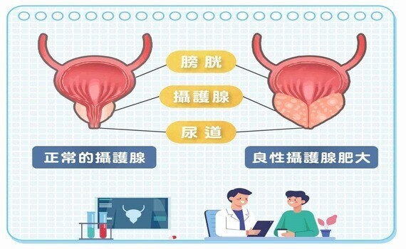 天冷尿不出來！ 攝護腺肥大惹禍！微創雷射攝護腺剜除術 無傷口恢復快 - https://www.watchmedia01.com