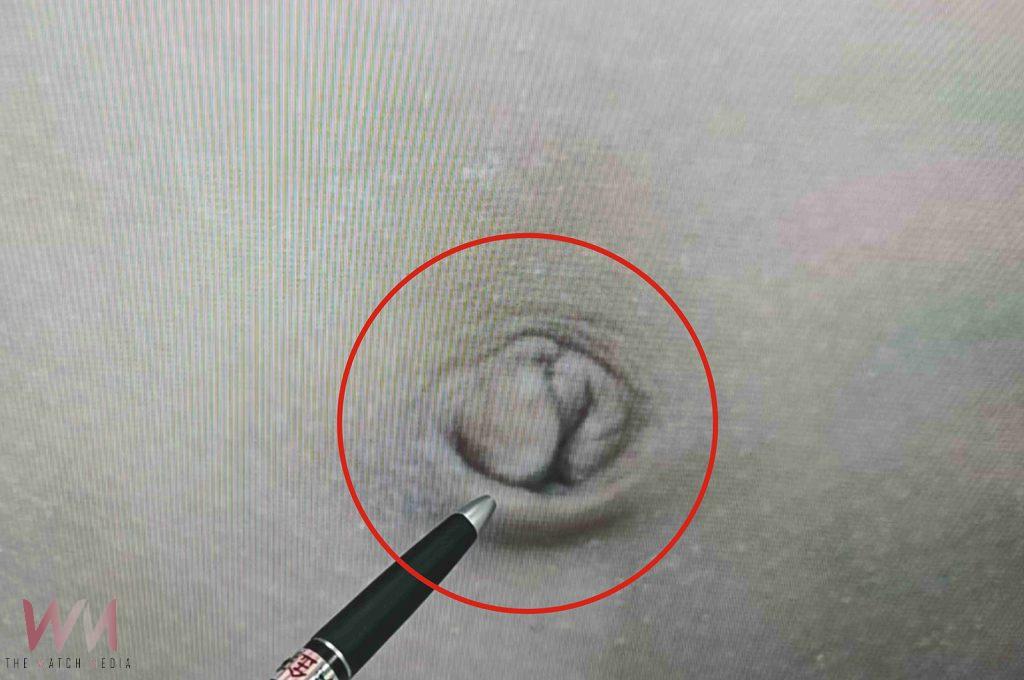 「腹腔鏡微創單孔疝氣修補手術」最主要好處是傷口美觀，不管一側或兩側，都是同一個傷口，藏在肚臍裡面。（彰基醫院提供）