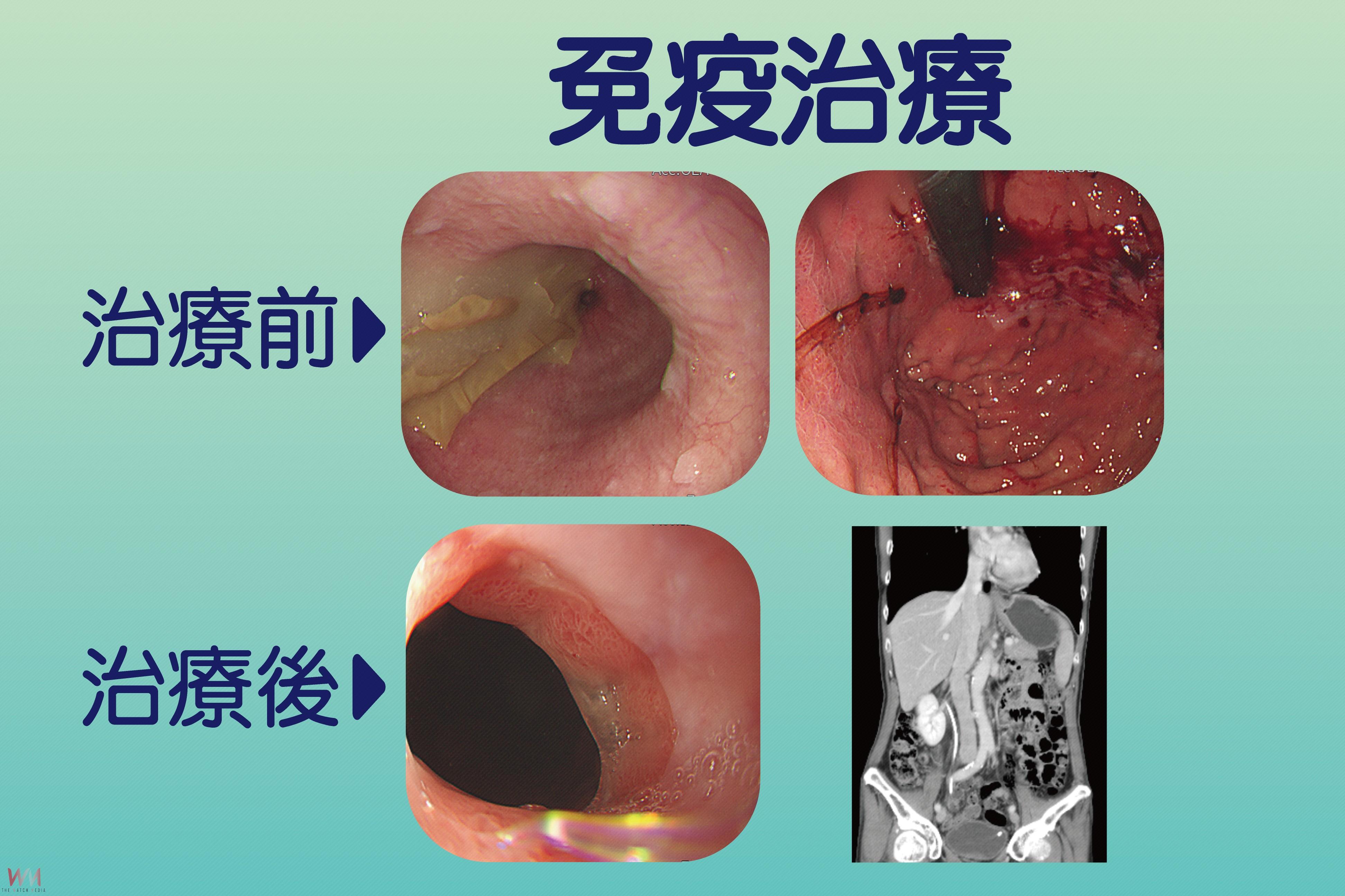 翻轉棘手胃癌　台中慈濟醫院成績緊追日韓數據亮眼 - https://www.watchmedia01.com