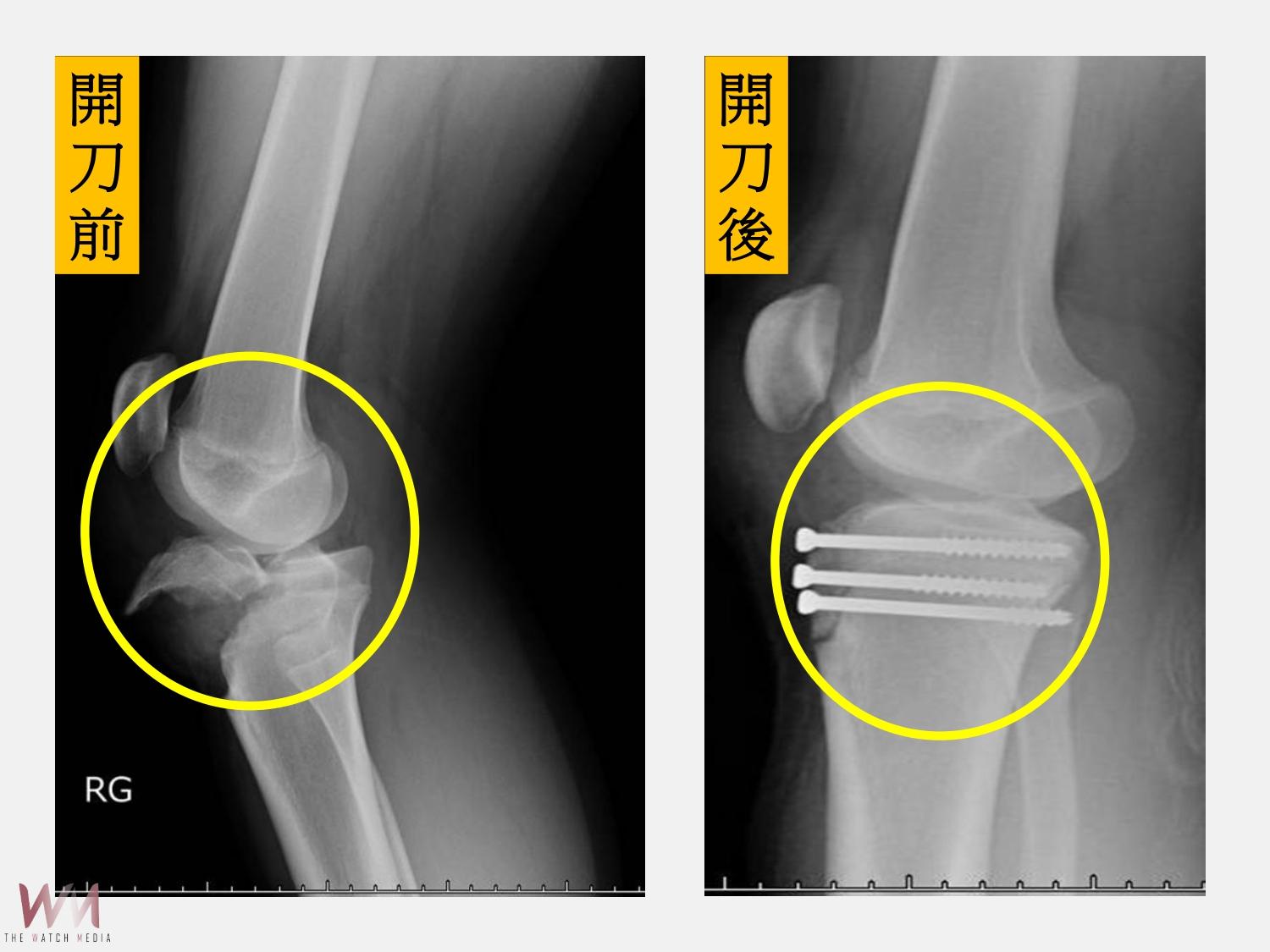 右膝近端脛骨骨折合併生長板受損　仁愛長庚：復位固定手術助復原 - https://www.watchmedia01.com