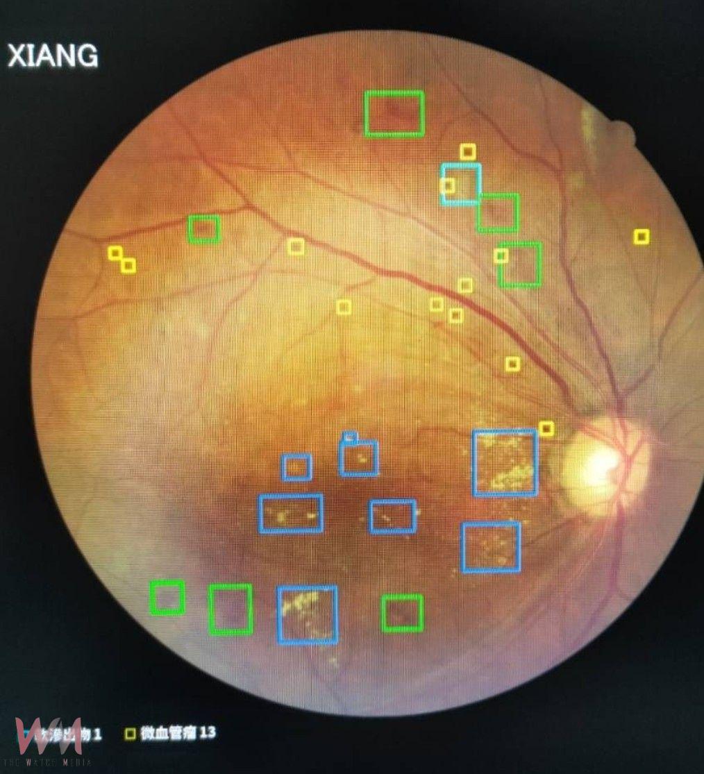 糖友注意！晶亮計劃-免散瞳+AI判讀　5分鐘搞定 - https://www.watchmedia01.com