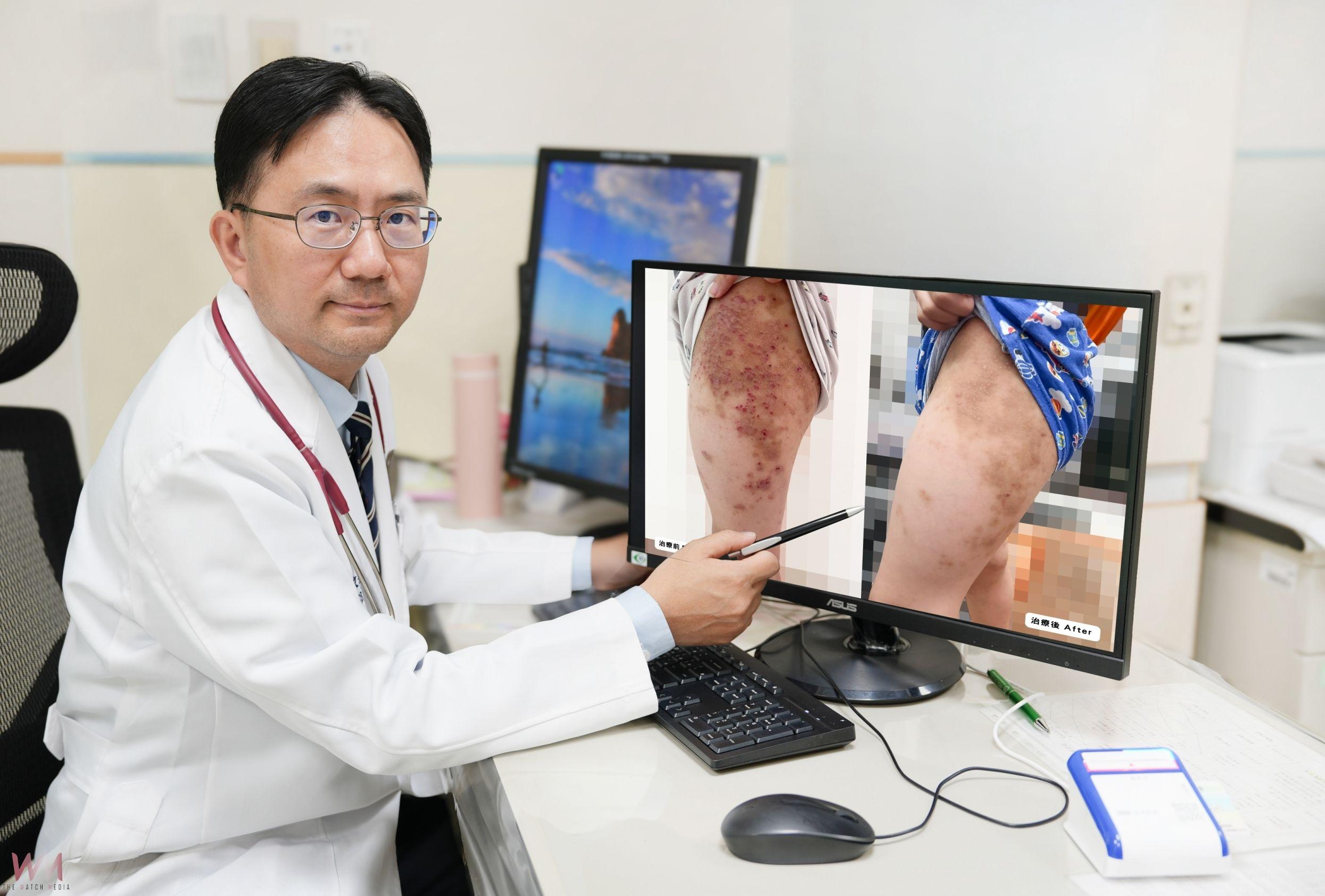 異位性皮膚炎新療法　中醫大兒醫：生物製劑助孩童擺脫長期紅疹與搔癢 - https://www.watchmedia01.com