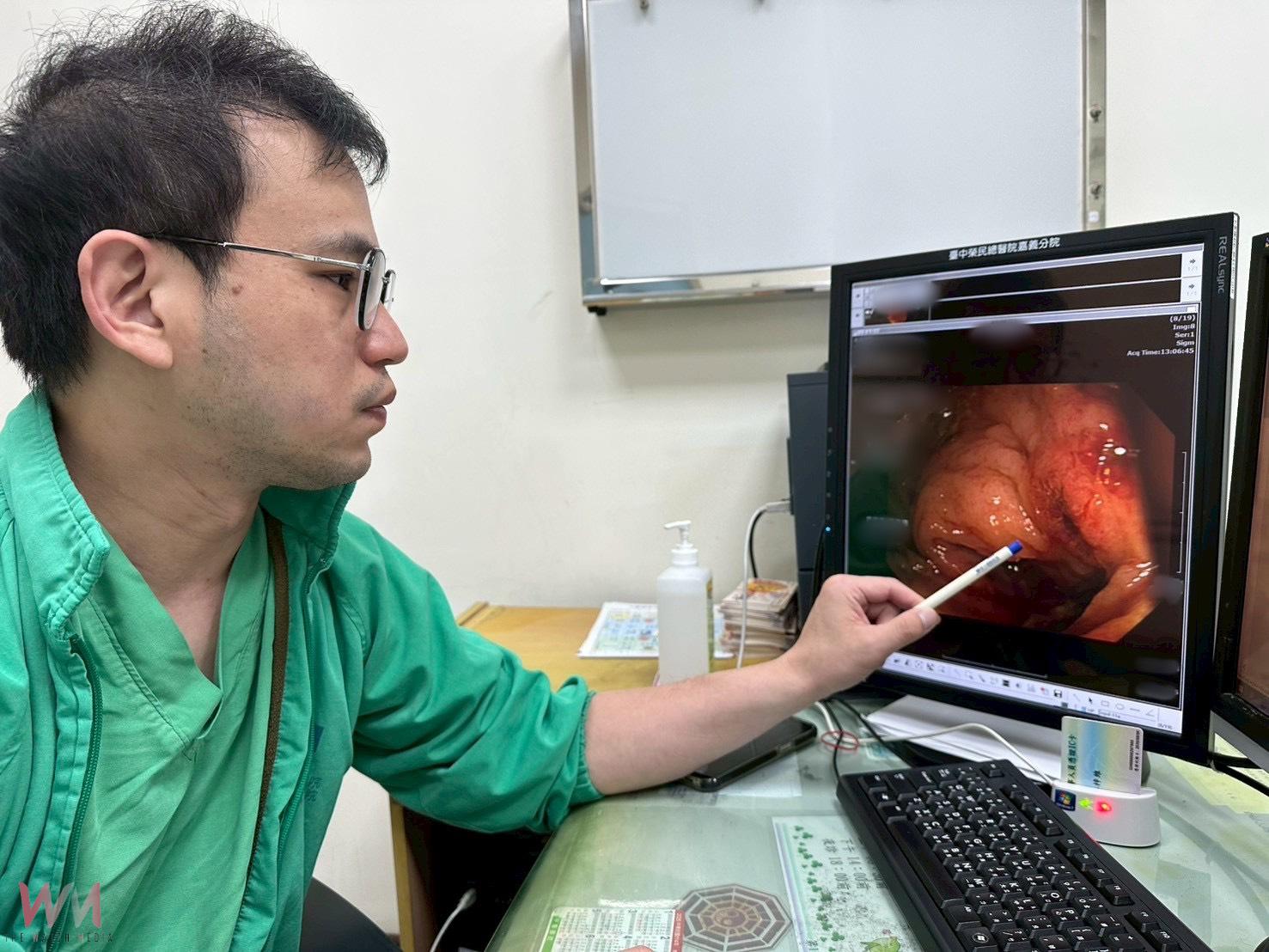良性息肉轉化成惡性大腸癌 及早切除及早治療「腸」保安康 - https://www.watchmedia01.com