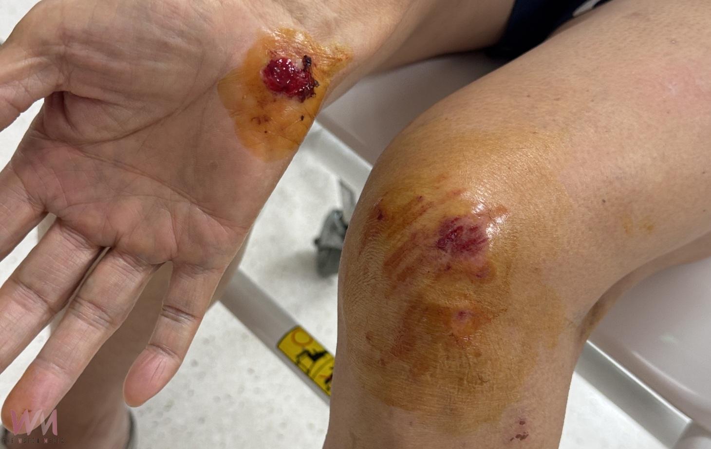 北港老嫗夜歸遭人行道突起柏油絆倒　臉部著地多處受傷盼儘速改善 - https://www.watchmedia01.com