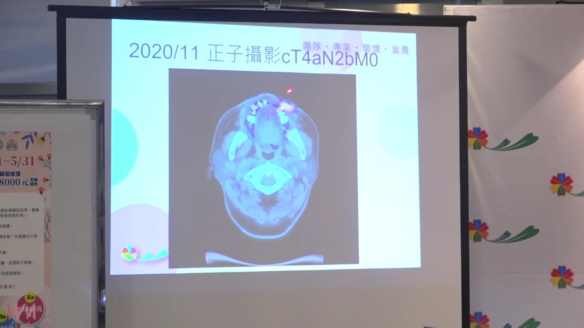 （有影片）／一張海報救了我！彰化婦早期發現乳癌康復後回醫院當志工 - https://www.watchmedia01.com
