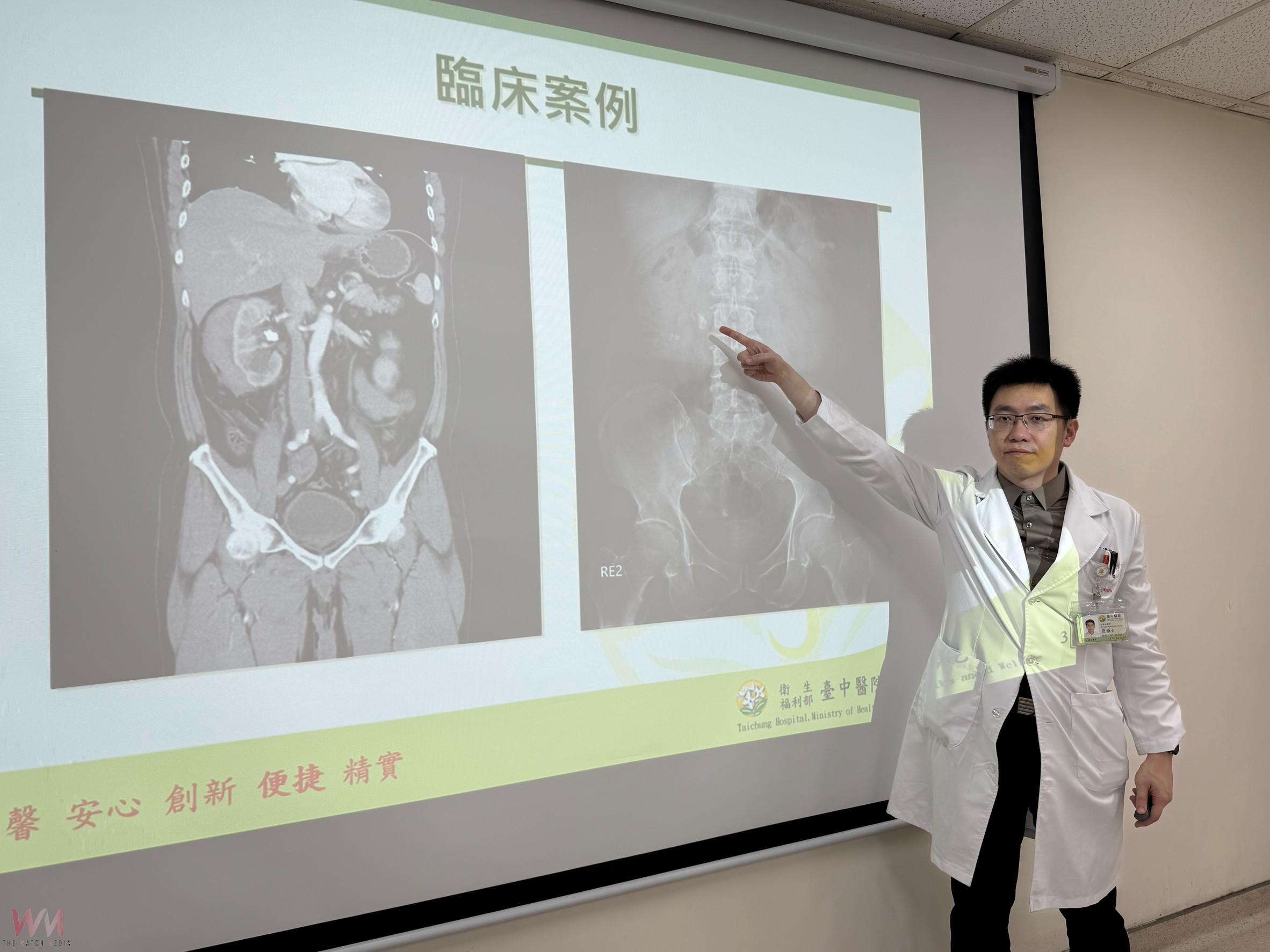 61歲男久坐少喝水兩年3度腎結石 體外震波不成 「軟」擊石治療成功 - https://www.watchmedia01.com