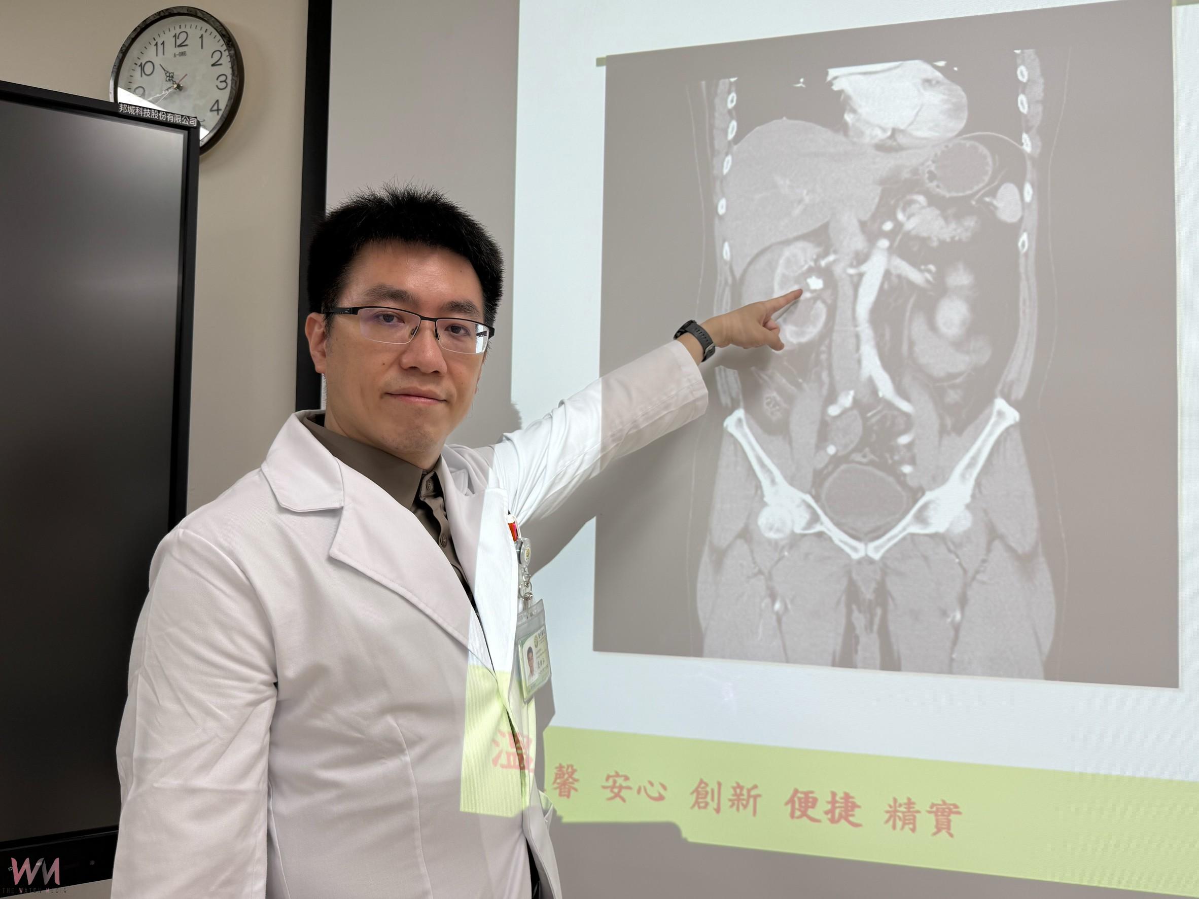 61歲男久坐少喝水兩年3度腎結石　體外震波不成 「軟」擊石治療成功 - https://www.watchmedia01.com