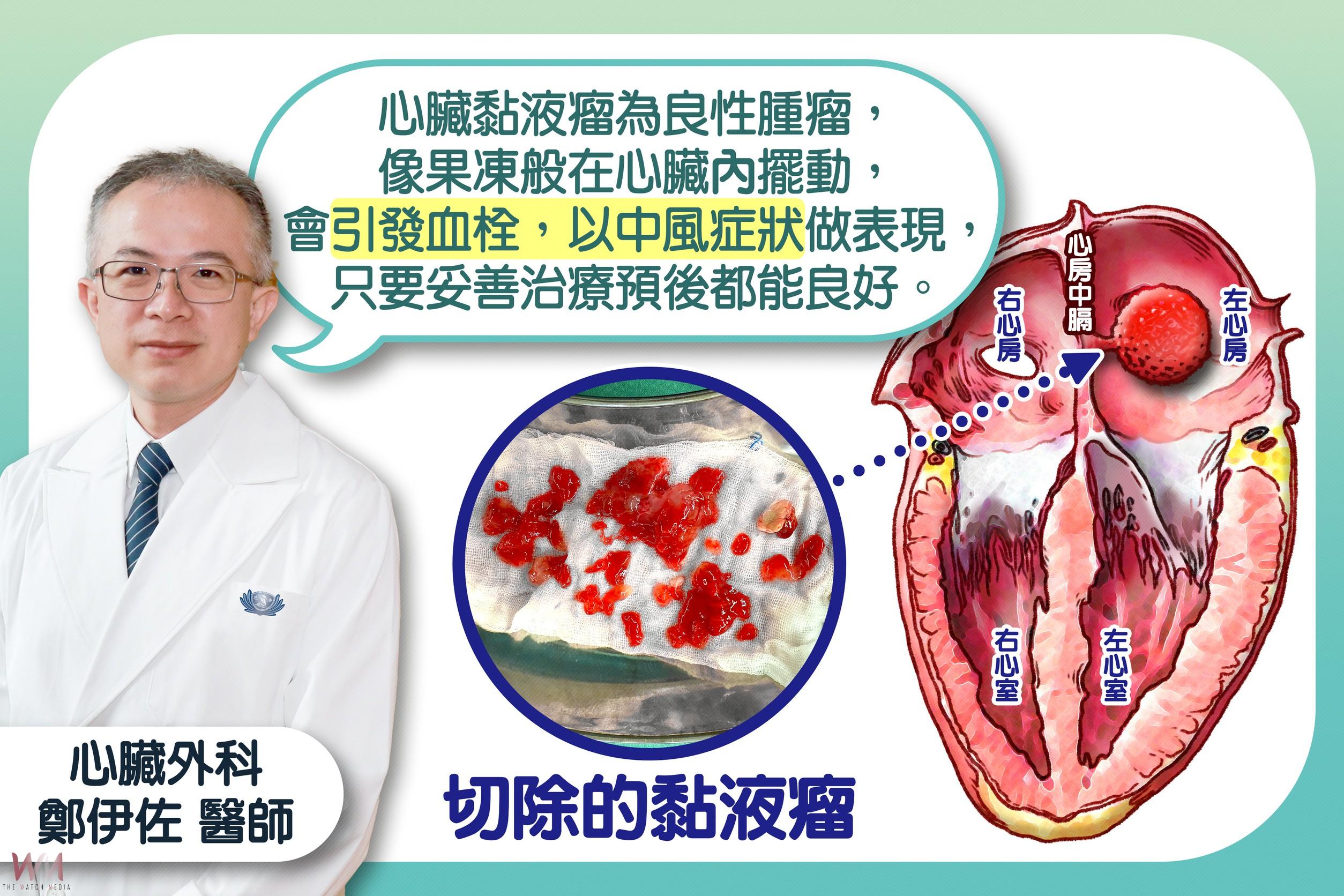 中風竟是心臟黏液瘤作怪　台中慈醫：６旬婦微創開心手術成功救命 - https://www.watchmedia01.com