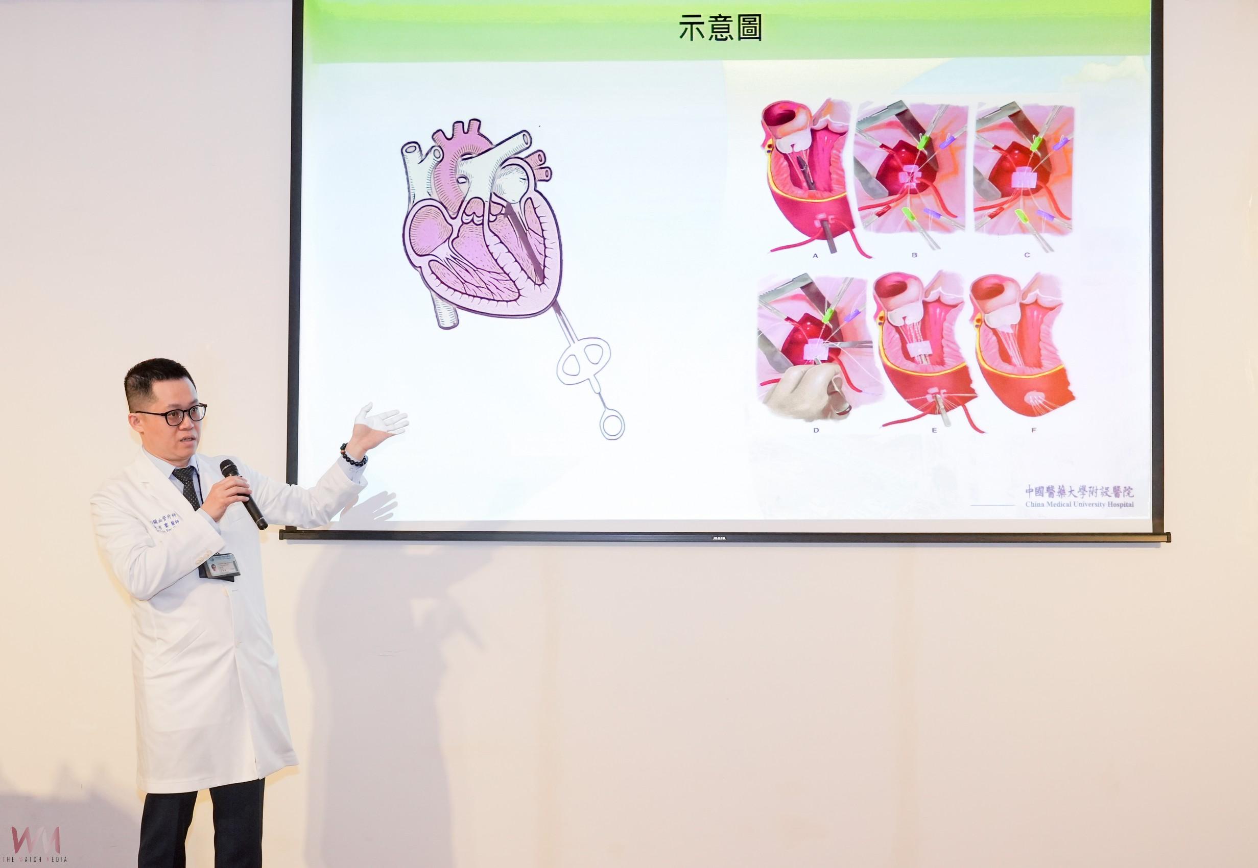 「心臟雙重爆擊」！全台首例NeoChord+PCI整合手術　免開胸助重啟心生 - https://www.watchmedia01.com