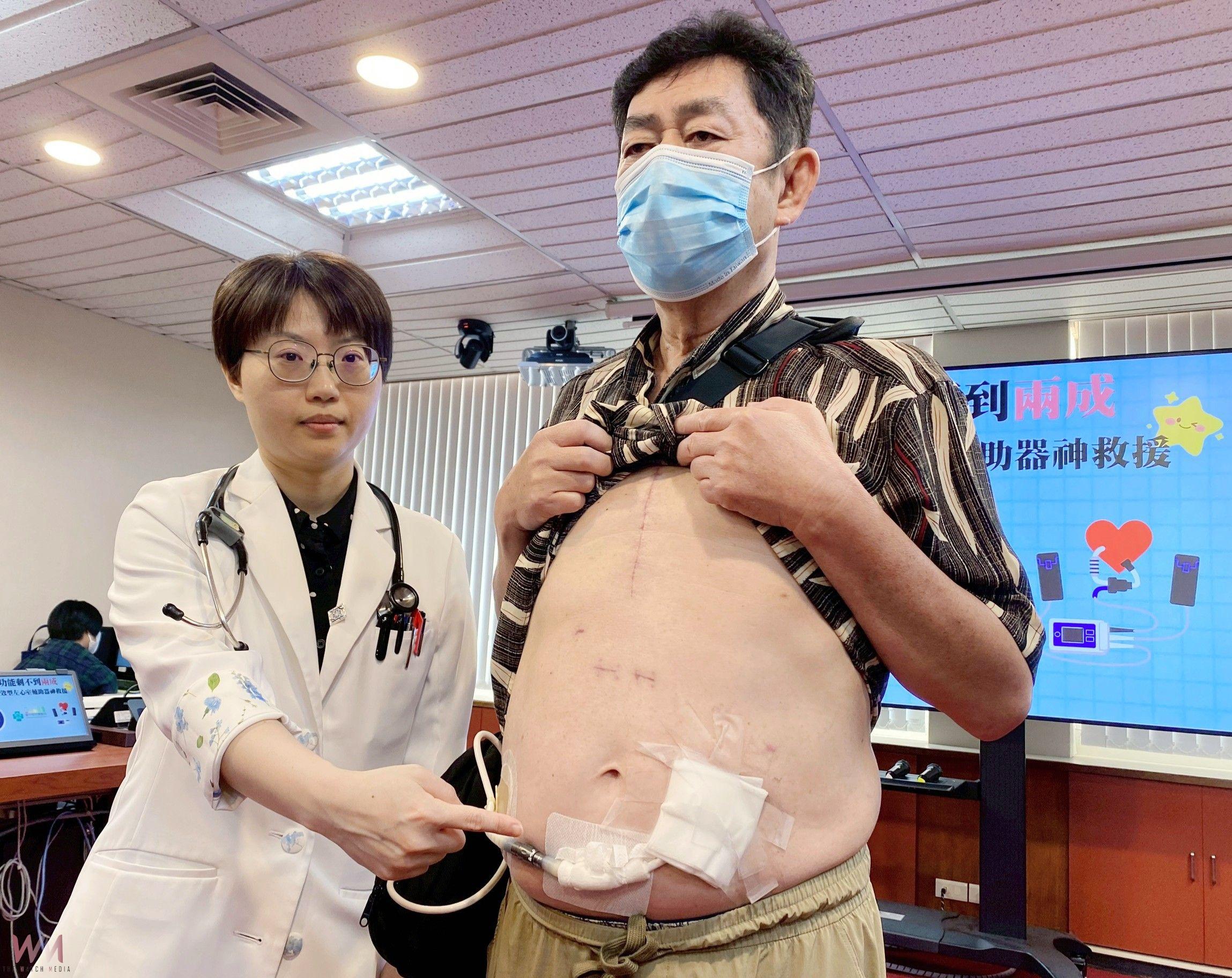 心臟功能剩不到兩成　中榮醫：植入式長效型左心室輔助器神救援 - https://www.watchmedia01.com
