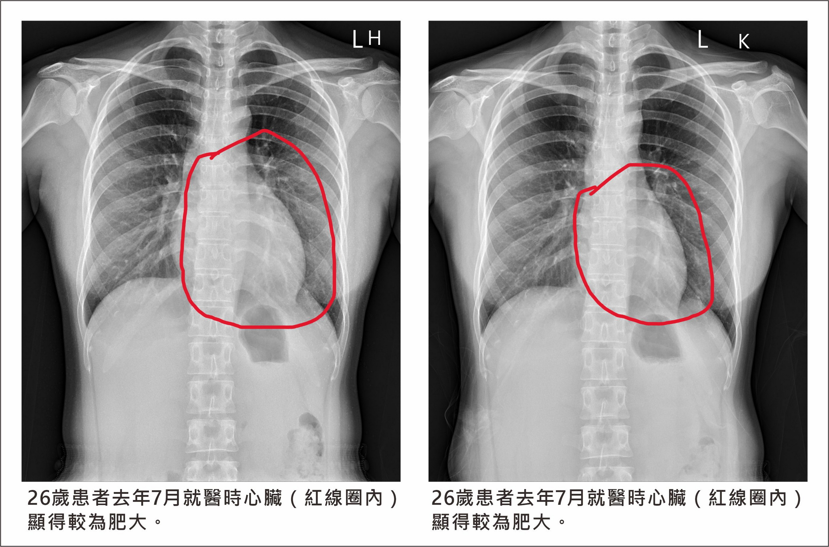 年輕女子健檢意外發現心臟衰竭　藥物治療10個月奇蹟康復 - https://www.watchmedia01.com