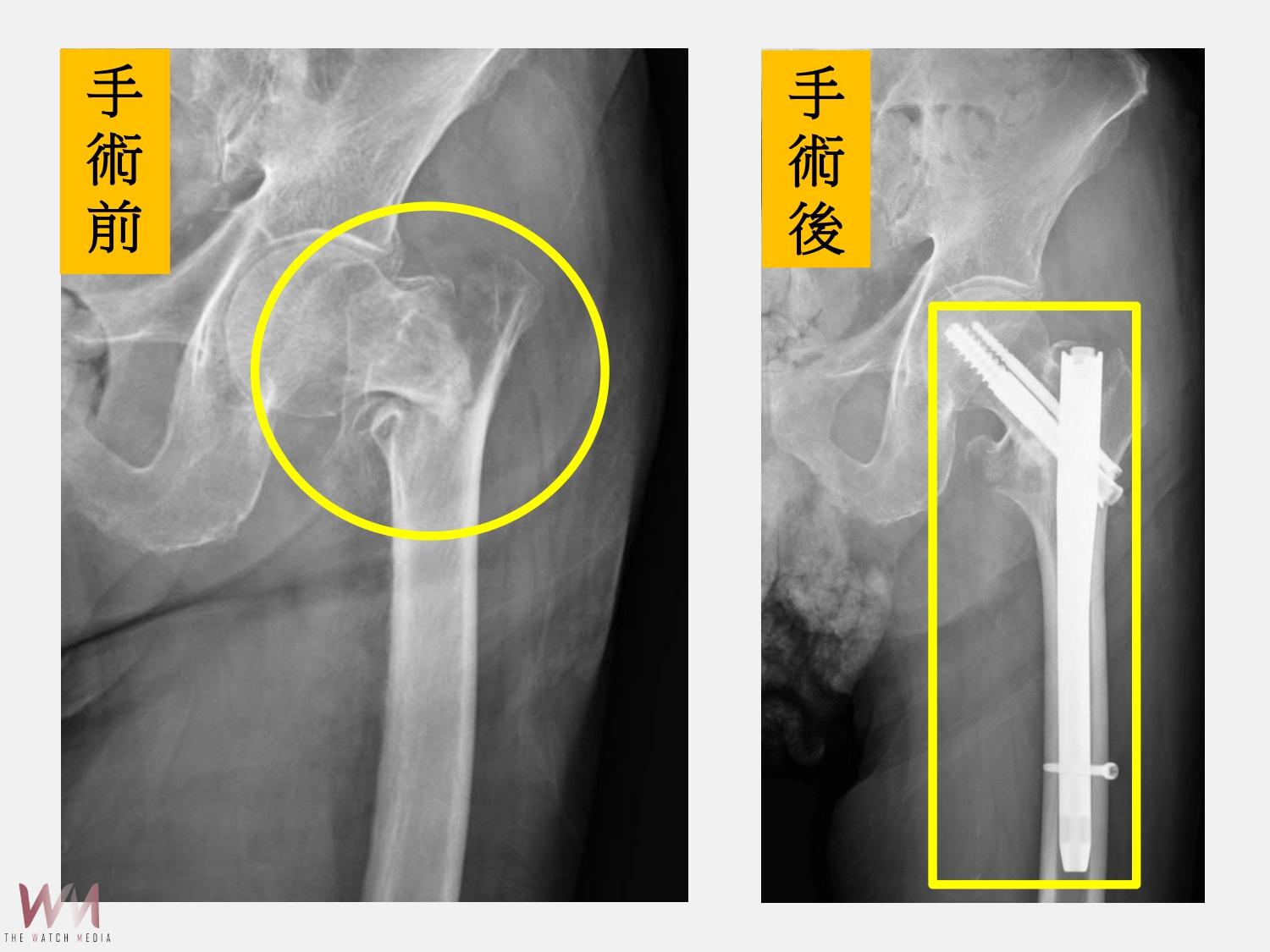 9旬阿祖髖關節骨折　中西醫整合照護 兩週出院享天倫之樂 - https://www.watchmedia01.com