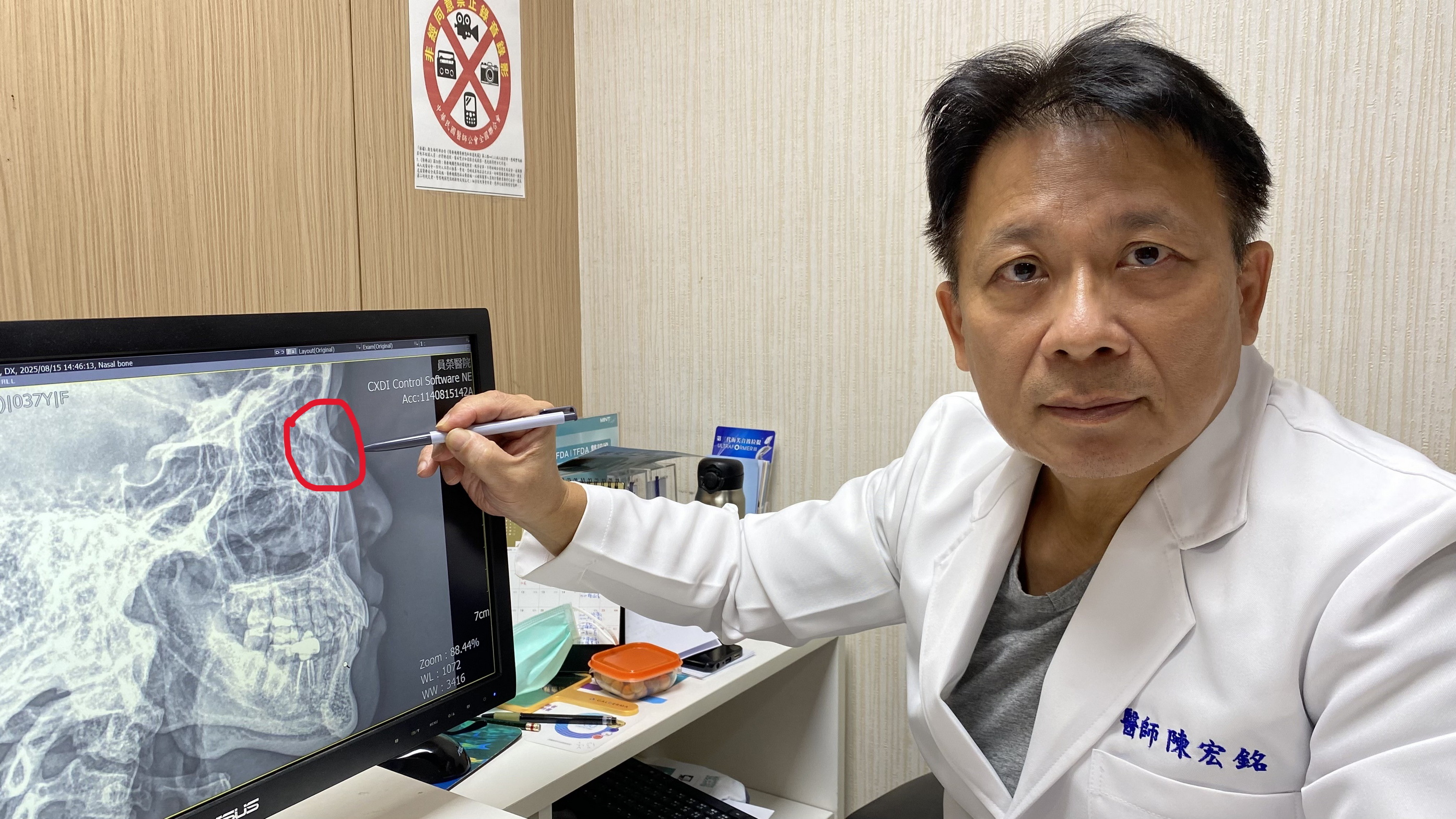 (有影片)/母親抱娃鼻骨斷裂 醫師提醒:顏面骨折外觀輕微卻暗藏危機 - https://www.watchmedia01.com