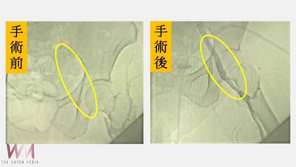 7旬婦人復健過程中左腿突劇烈腫脹　禍首竟是髂靜脈壓迫症候群 - https://www.watchmedia01.com