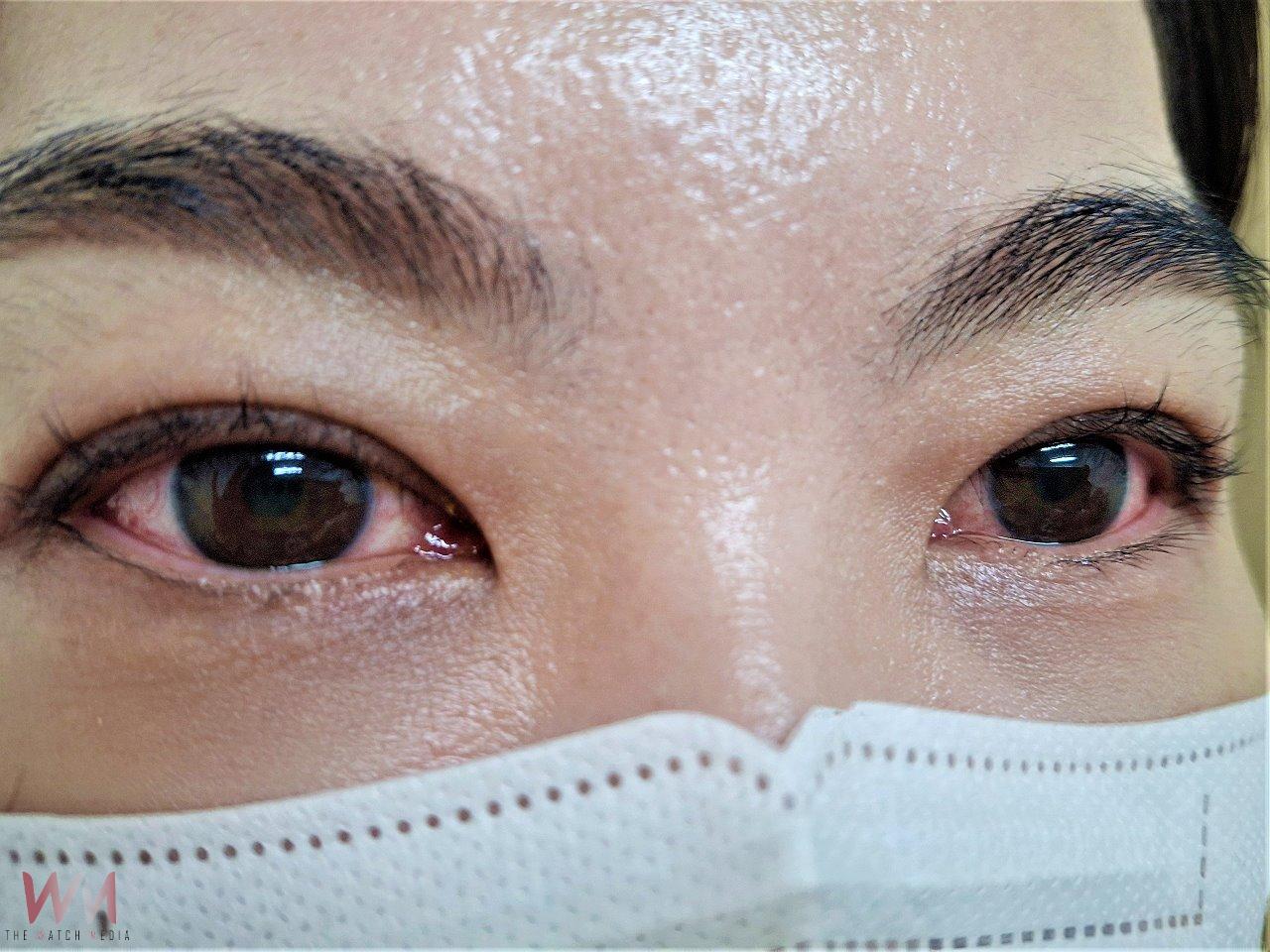 眼睛紅腫、癢、灼熱感、流淚　莫將急性結膜炎誤認是過敏 - https://www.watchmedia01.com