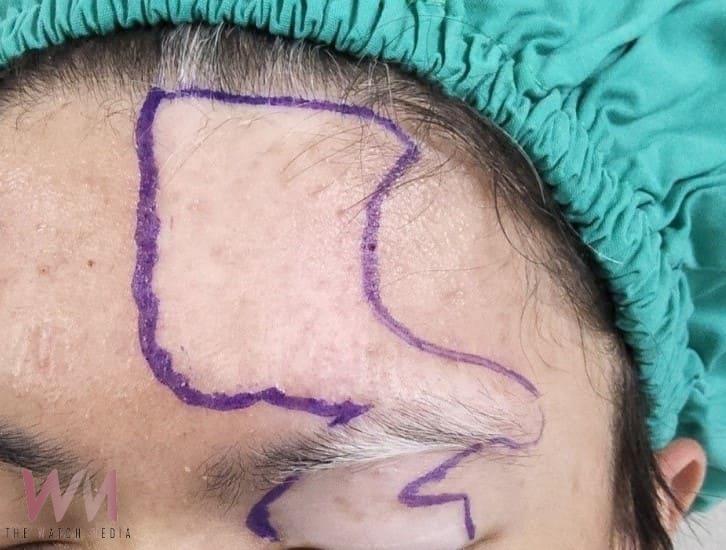 20歲少年戴帽兩年　同儕異樣眼光讓他「不敢抬頭」　醫生助恢復自信 - https://www.watchmedia01.com