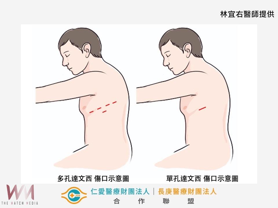 5旬男健檢意外發現肺部腫瘤　單孔達文西手術精準切除 - https://www.watchmedia01.com