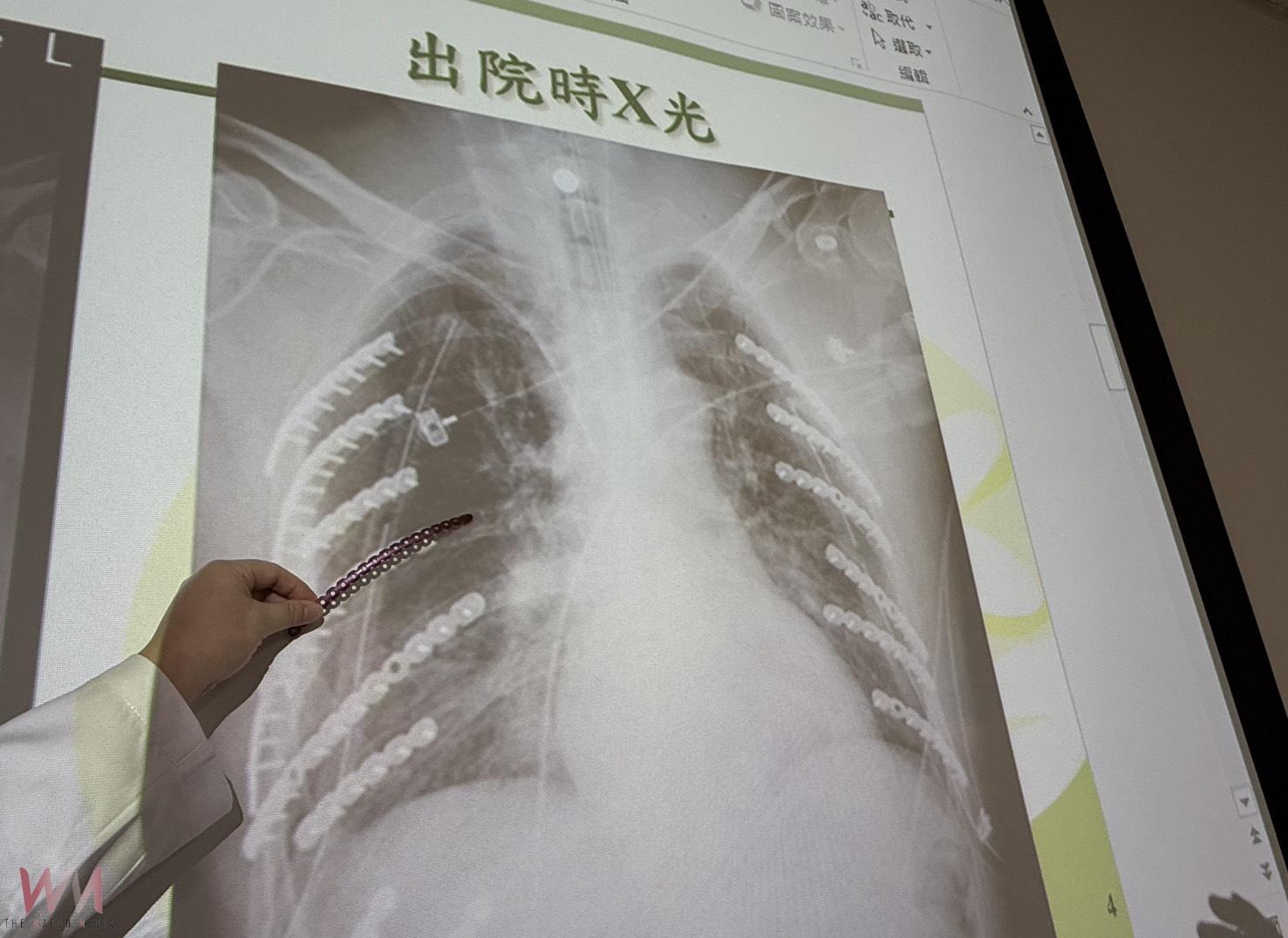 雙側肋骨遭工具車擠壓變形 14根鈦合金固定肋骨讓「鋼鐵人」重生 - https://www.watchmedia01.com