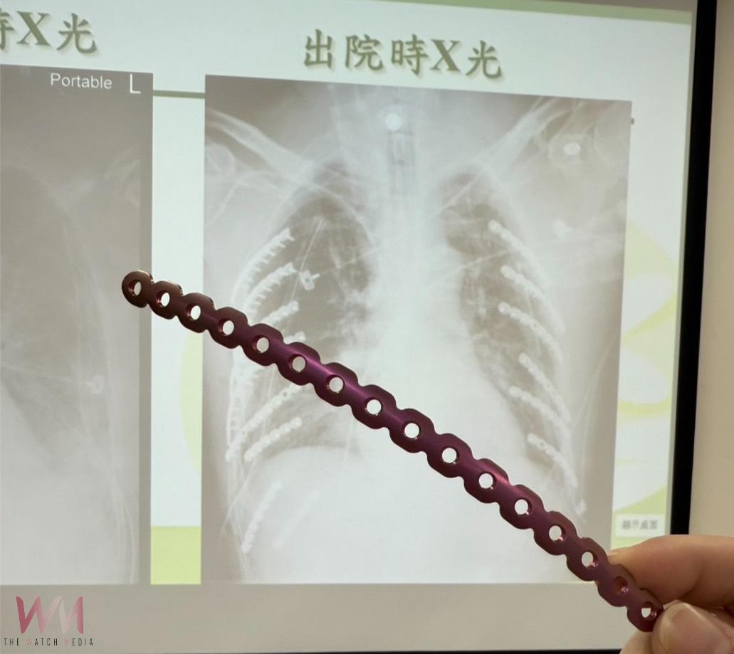 雙側肋骨遭工具車擠壓變形 14根鈦合金固定肋骨讓「鋼鐵人」重生 - https://www.watchmedia01.com