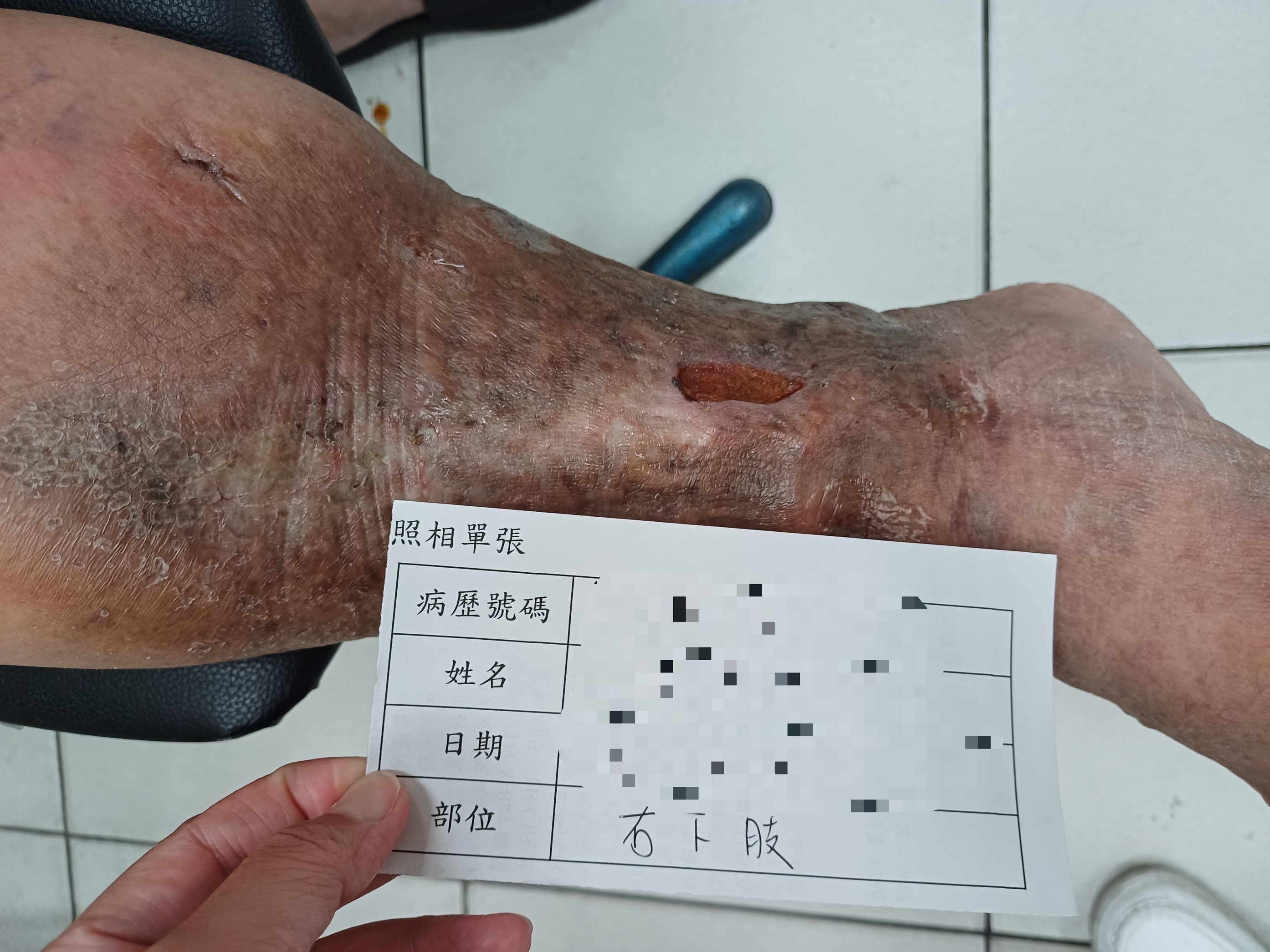 十年潰爛終癒合!員榮微創鐳射手術擺脫「靜脈曲張潰瘍」困擾 - https://www.watchmedia01.com